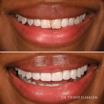 Cosmetic Services Gallery Before & After Gallery - Patient 232279 - Image 1