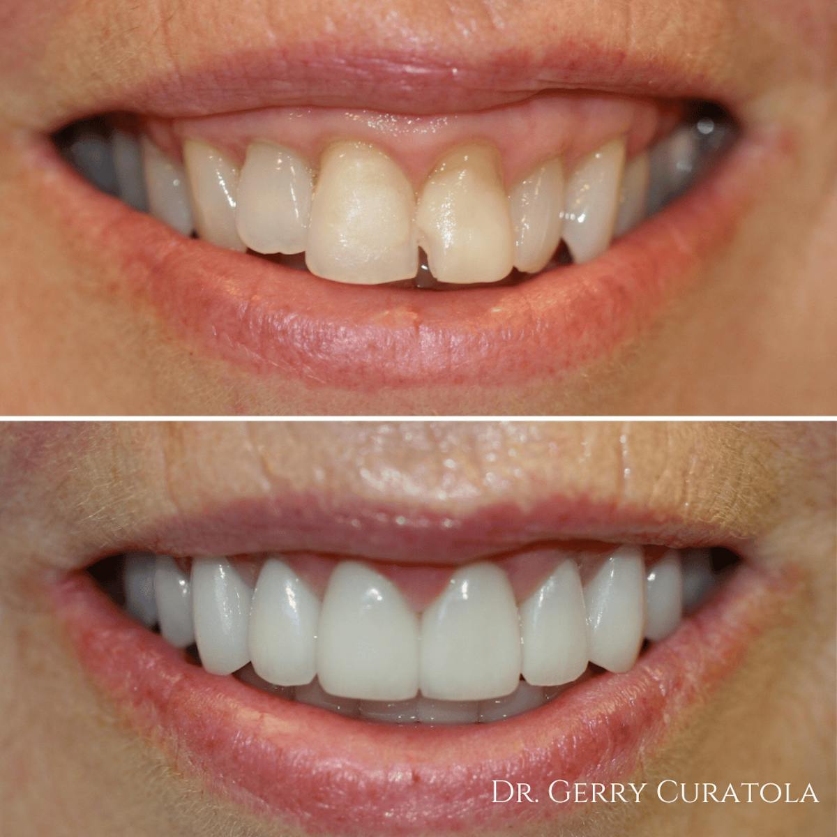 Cosmetic Services Gallery Before & After Gallery - Patient 125735 - Image 1