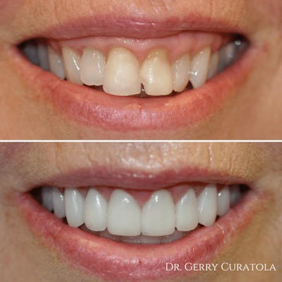 Cosmetic Services Gallery Before & After Gallery - Patient 125735 - Image 1