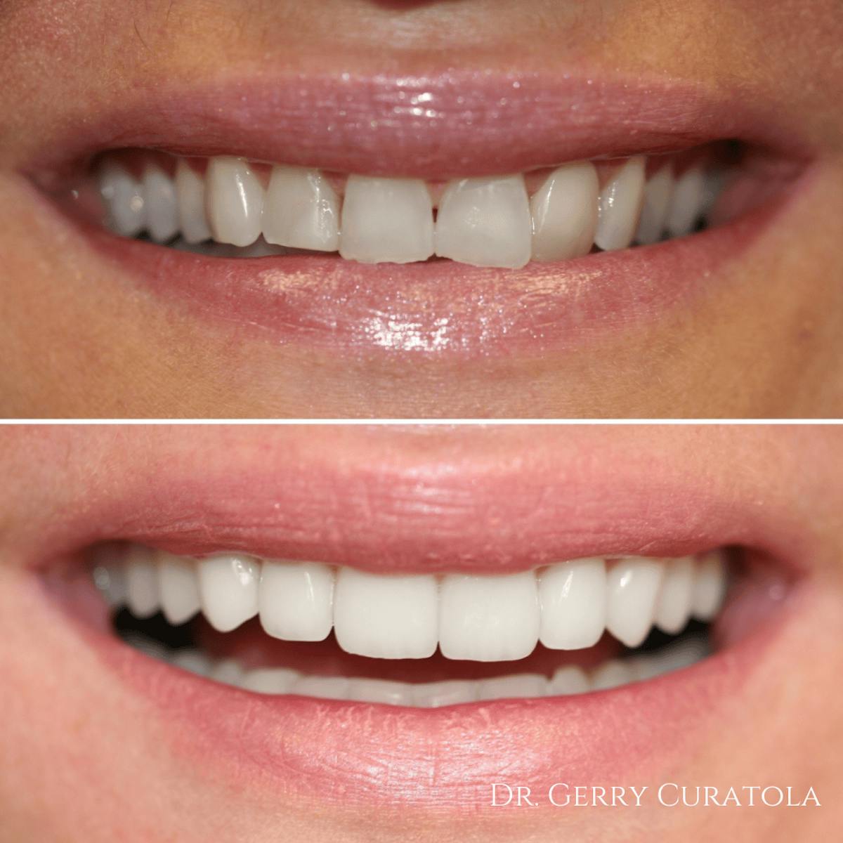 Cosmetic Services Gallery Before & After Gallery - Patient 215866 - Image 1