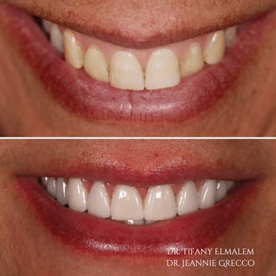 Cosmetic Services Gallery Before & After Gallery - Patient 138705 - Image 1