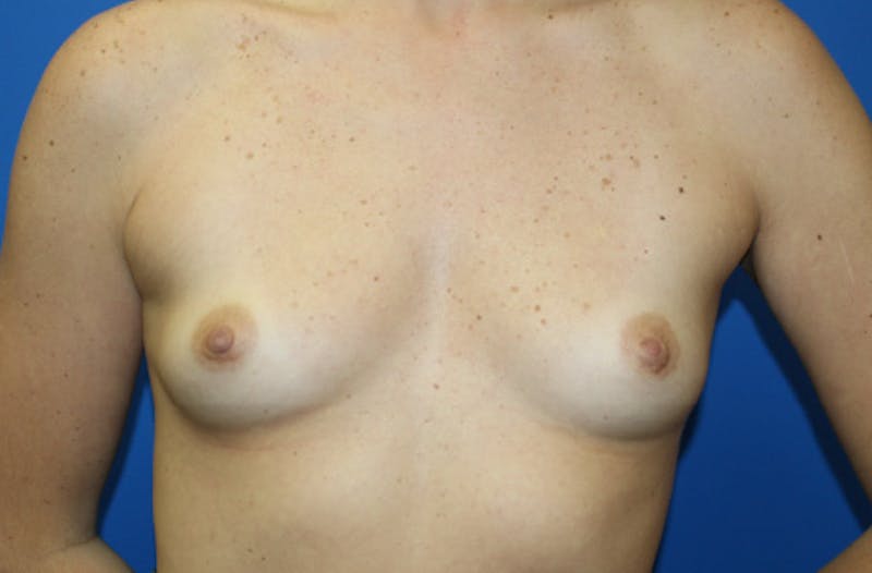 Breast Augmentation Before & After Gallery - Patient 628656 - Image 1