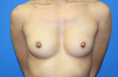 Breast Augmentation Before & After Gallery - Patient 214771 - Image 1