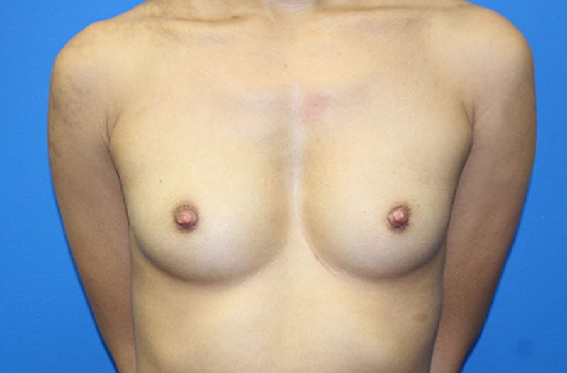 Breast Augmentation Before & After Gallery - Patient 214771 - Image 1