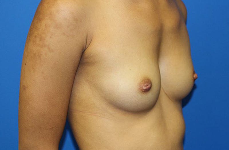 Breast Augmentation Before & After Gallery - Patient 214771 - Image 3