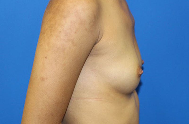 Breast Augmentation Before & After Gallery - Patient 214771 - Image 5