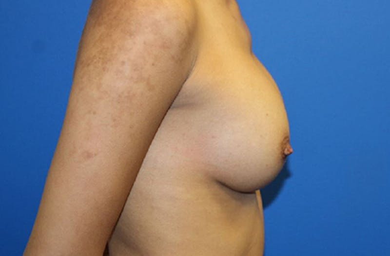 Breast Augmentation Before & After Gallery - Patient 214771 - Image 6