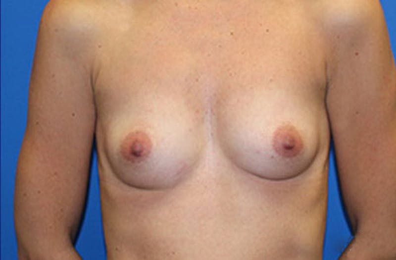 Breast Augmentation Before & After Gallery - Patient 350384 - Image 1