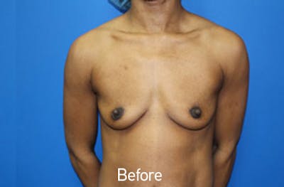 Breast Augmentation Before & After Gallery - Patient 326151 - Image 1