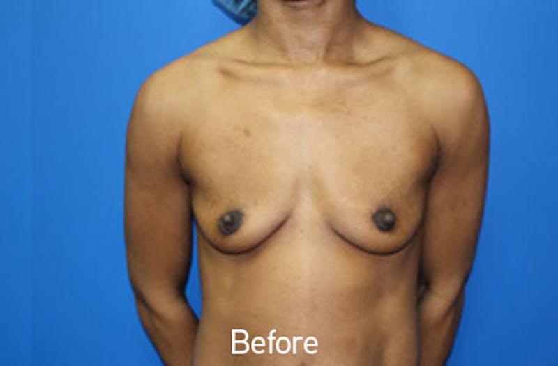 Breast Augmentation Before & After Gallery - Patient 326151 - Image 1