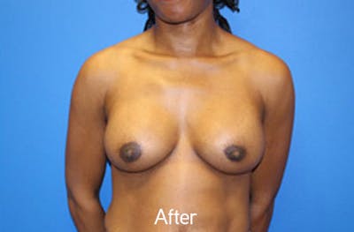 Breast Augmentation Before & After Gallery - Patient 326151 - Image 2