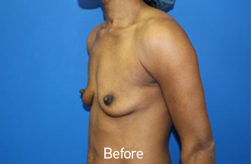 Breast Augmentation Before & After Gallery - Patient 326151 - Image 3