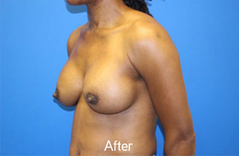 Breast Augmentation Before & After Gallery - Patient 326151 - Image 4