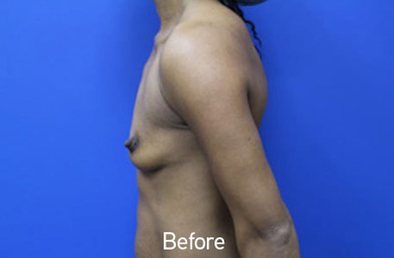 Breast Augmentation Before & After Gallery - Patient 326151 - Image 5