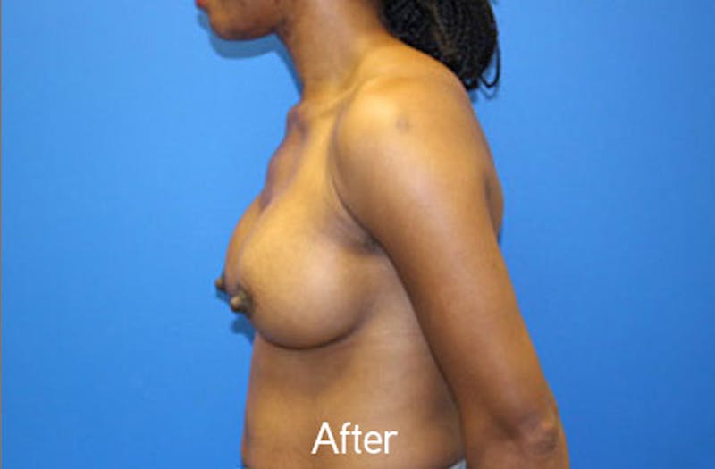 Breast Augmentation Before & After Gallery - Patient 326151 - Image 6