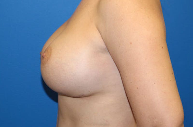Breast Augmentation Before & After Gallery - Patient 391421 - Image 6