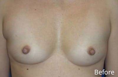 Breast Augmentation Before & After Gallery - Patient 345177 - Image 1