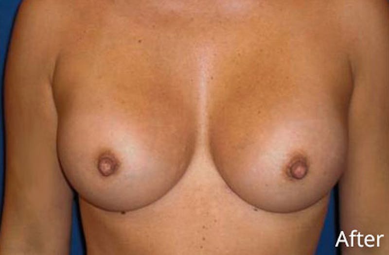 Breast Augmentation Before & After Gallery - Patient 345177 - Image 2