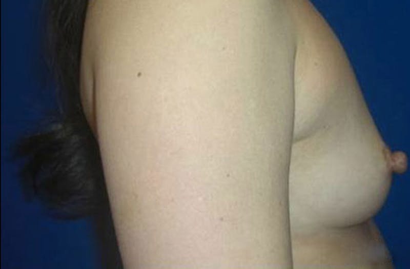 Breast Augmentation Before & After Gallery - Patient 345177 - Image 5