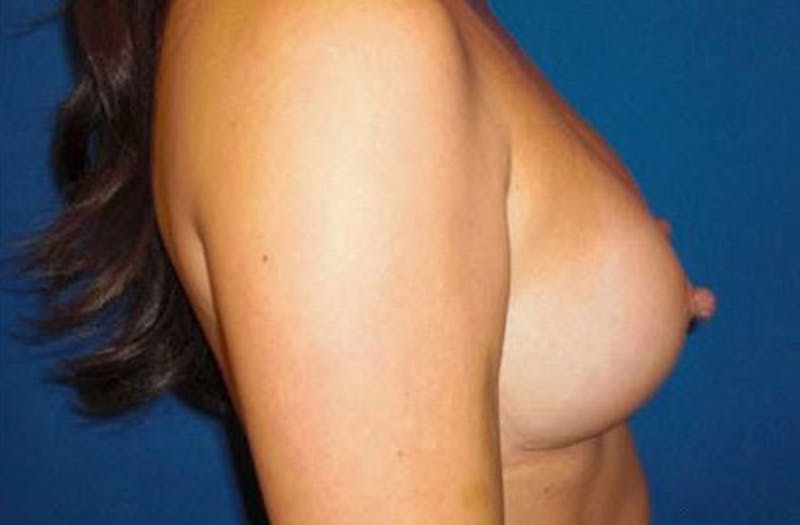 Breast Augmentation Before & After Gallery - Patient 345177 - Image 6