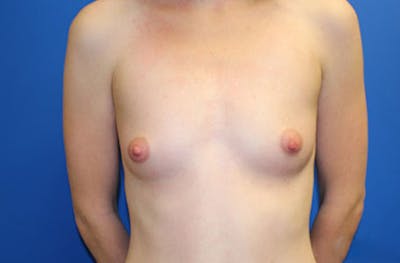 Breast Augmentation Before & After Gallery - Patient 370377 - Image 1