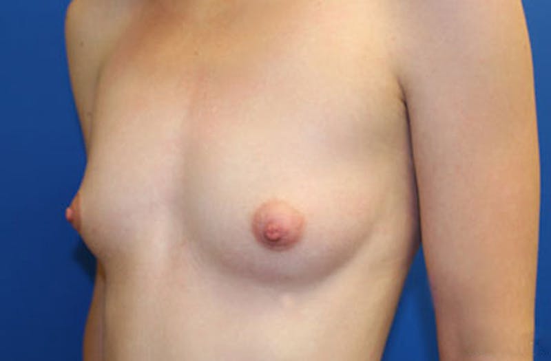 Breast Augmentation Before & After Gallery - Patient 370377 - Image 3