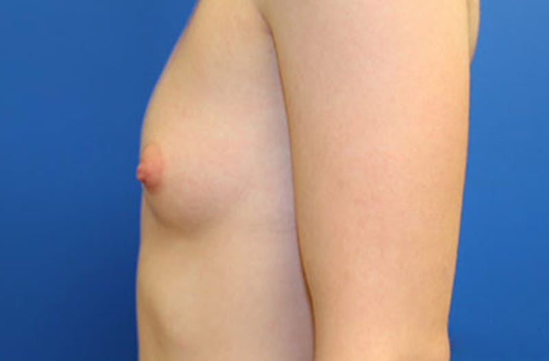 Breast Augmentation Before & After Gallery - Patient 370377 - Image 5