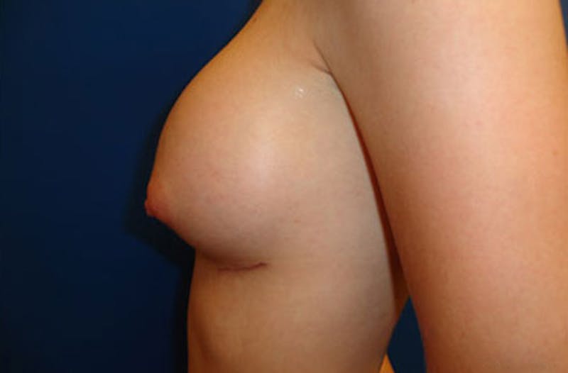 Breast Augmentation Before & After Gallery - Patient 370377 - Image 6