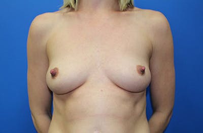 Breast Augmentation Before & After Gallery - Patient 388085 - Image 1