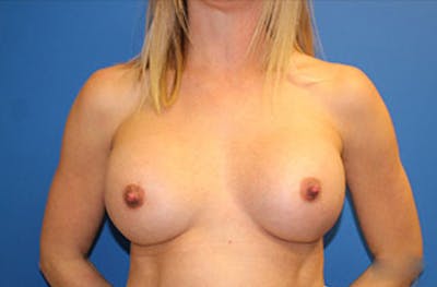 Breast Augmentation Before & After Gallery - Patient 388085 - Image 2