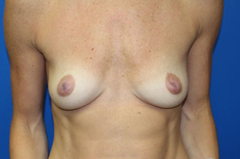 Breast Augmentation Before & After Gallery - Patient 710823 - Image 1