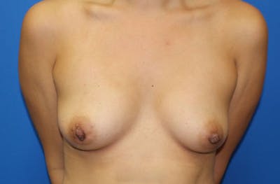 Breast Augmentation Before & After Gallery - Patient 412704 - Image 1