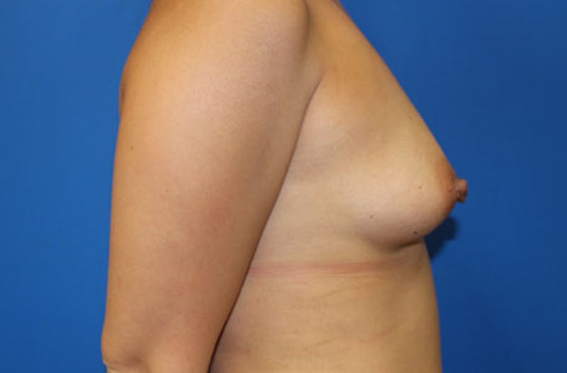 Breast Augmentation Before & After Gallery - Patient 412704 - Image 5