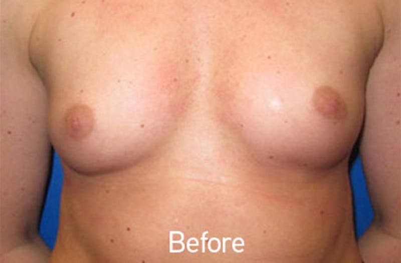 Breast Augmentation Before & After Gallery - Patient 242436 - Image 1