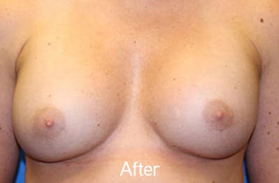 Breast Augmentation Before & After Gallery - Patient 242436 - Image 2