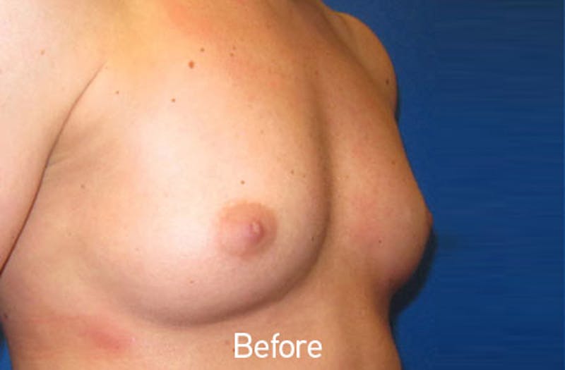 Breast Augmentation Before & After Gallery - Patient 242436 - Image 3
