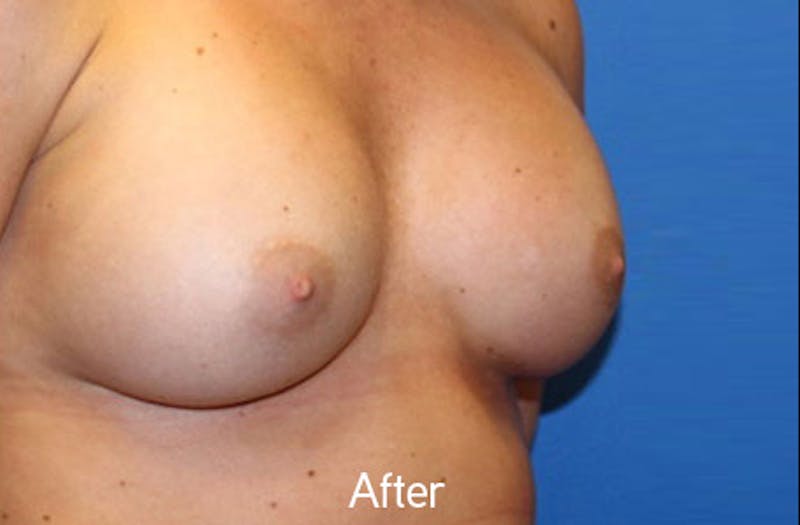 Breast Augmentation Before & After Gallery - Patient 242436 - Image 4