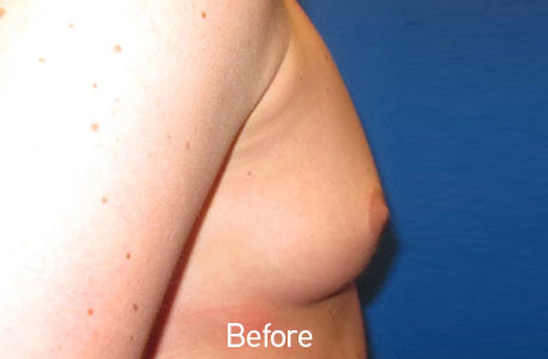 Breast Augmentation Before & After Gallery - Patient 242436 - Image 5