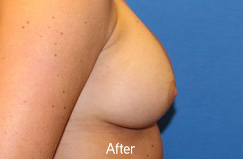 Breast Augmentation Before & After Gallery - Patient 242436 - Image 6