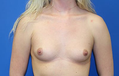 Breast Augmentation Before & After Gallery - Patient 676964 - Image 1