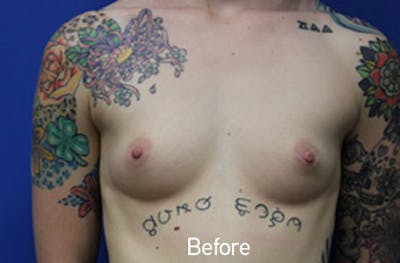Breast Augmentation Before & After Gallery - Patient 785991 - Image 1