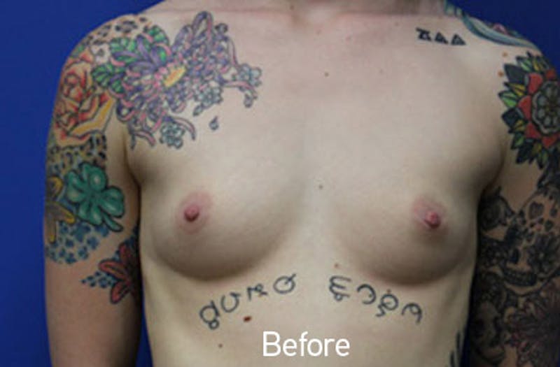 Breast Augmentation Before & After Gallery - Patient 785991 - Image 1