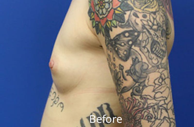 Breast Augmentation Before & After Gallery - Patient 785991 - Image 3