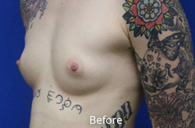 Breast Augmentation Before & After Gallery - Patient 785991 - Image 5