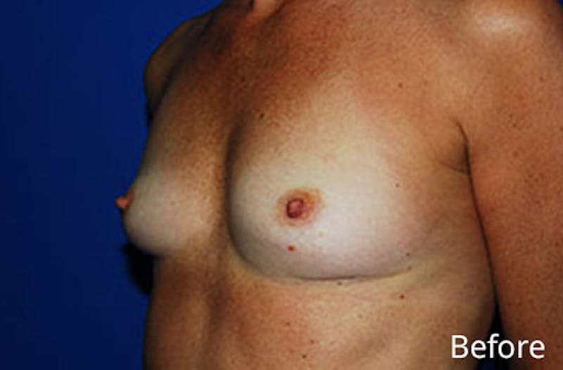 Breast Augmentation Before & After Gallery - Patient 238843 - Image 1