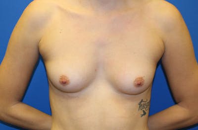 Breast Augmentation Before & After Gallery - Patient 970158 - Image 1