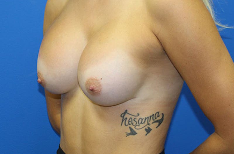 Breast Augmentation Before & After Gallery - Patient 970158 - Image 4