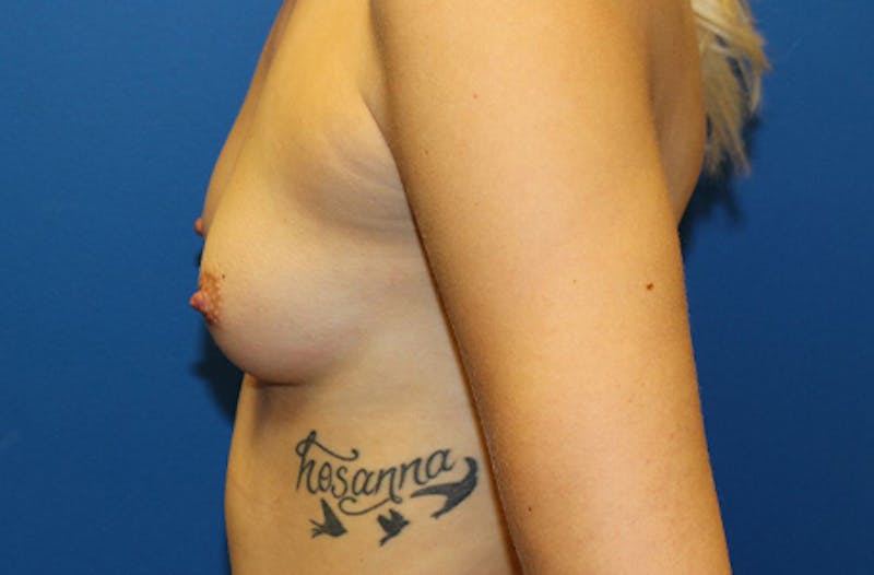 Breast Augmentation Before & After Gallery - Patient 970158 - Image 5