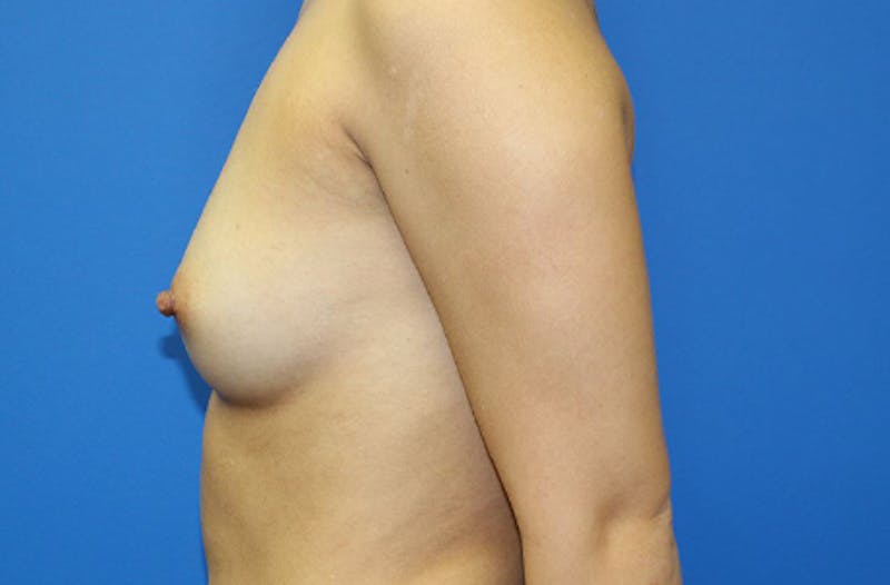 Breast Augmentation Before & After Gallery - Patient 358241 - Image 5