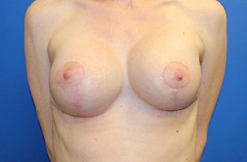 Breast Augmentation Revision Before & After Gallery - Patient 262083 - Image 2